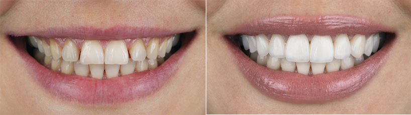 Veneers in Bromley