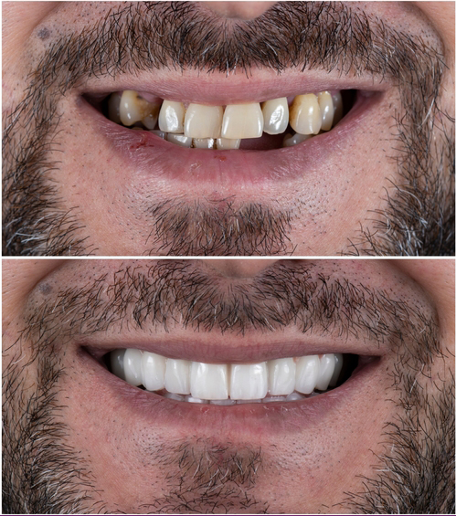 Crowns and Bridges before & after