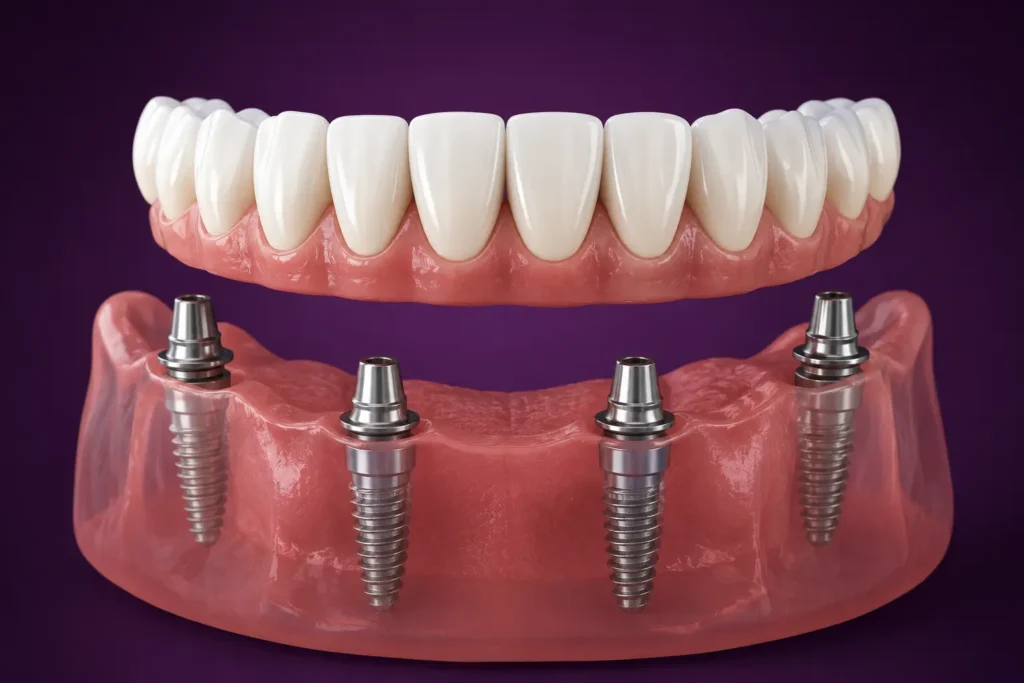 All-on-4 dental implant treatment at Bromley Smiles Dental Practice in Bromley