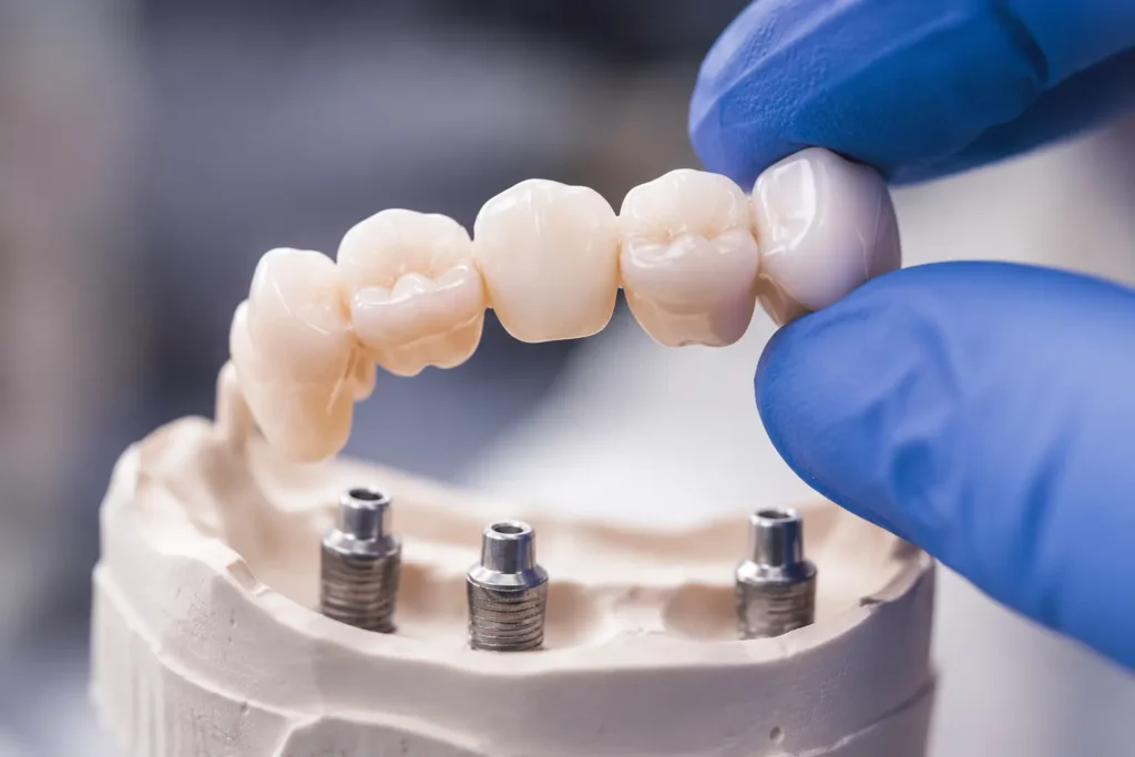 Custom dental prosthetics and implant restorations in Bromley