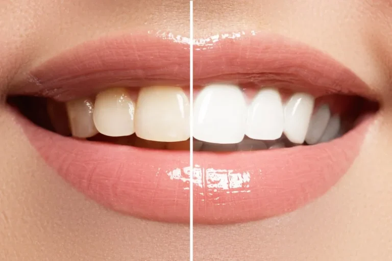 White-teeth-in-Keston