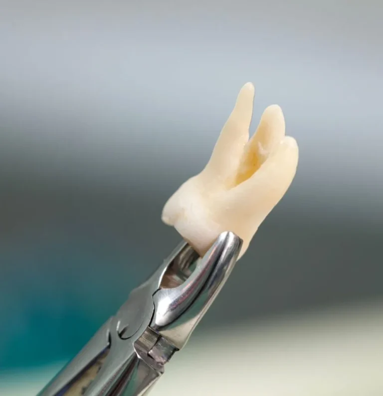 bromley-smiles-dental-tooth-extraction-in-general-dentistry