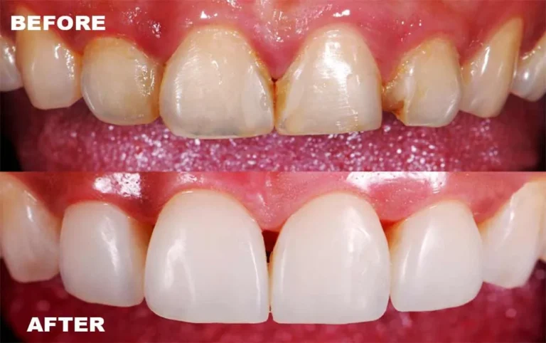 white-fillings